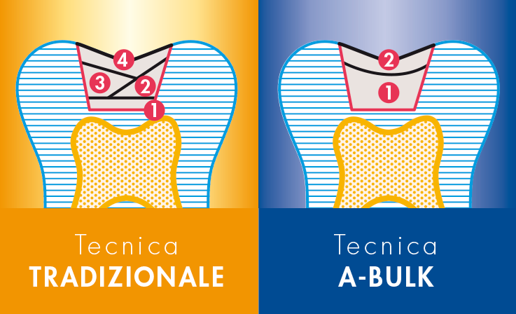 A-Bulk composito per tecnica bulk fill